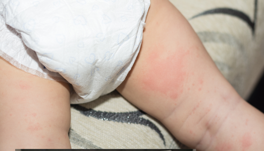 Diaper Rash: A Gentle Guide to Prevention for Busy Parents